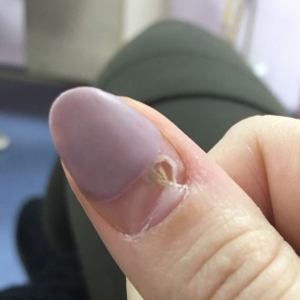 Daumen mit abgerissenem Nagel